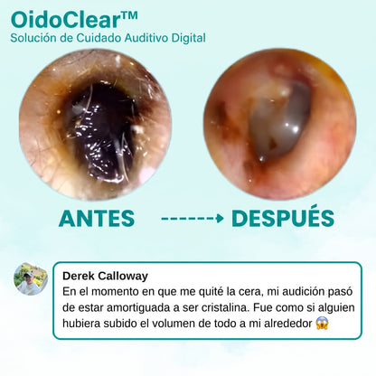 VisiónClean – Limpiador de Oídos con Cámara HD